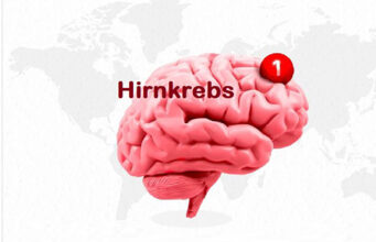 Antidepressivum Vortioxetin zeigt vielversprechende Ergebnisse bei Behandlung von Hirntumor