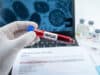 Erster Fall von Clade 1b Mpox in Großbritannien: Risiken, Schutzmaßnahmen und internationale Perspektiven
