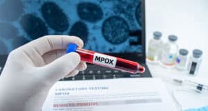 Erster Fall von Clade 1b Mpox in Großbritannien: Risiken, Schutzmaßnahmen und internationale Perspektiven