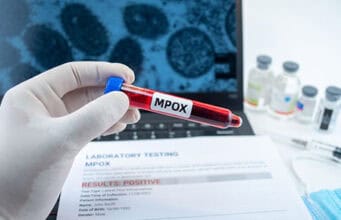 Erster Fall von Clade 1b Mpox in Großbritannien: Risiken, Schutzmaßnahmen und internationale Perspektiven