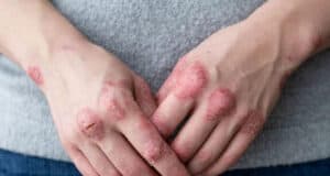 Trockene Haut im Winter: Ursachen, Tipps und die beste Pflege für gesunde Haut