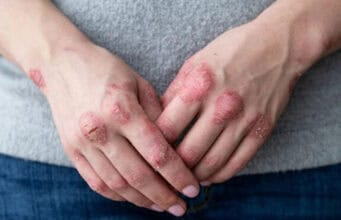 Trockene Haut im Winter: Ursachen, Tipps und die beste Pflege für gesunde Haut