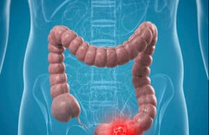 Wie Sie Darmkrebs effektiv vorbeugen: Tipps zur Früherkennung und gesunden Lebensweise